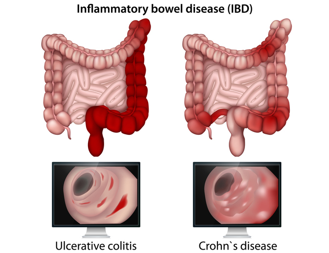 Illustration aftarme med Colitis ulcerosa vs. Morbus Crohn inflammatorisk tarmsygdom.