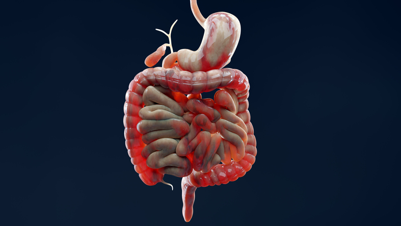 Morbus Crohns sygdom. Inflammatorisk tyktarm