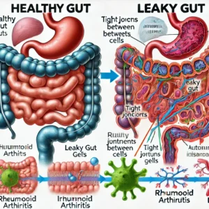Utætte tarme / Laeky gut og forbindelsen til autoimmune sygdomme